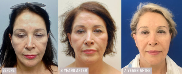 Minimally Invasive Midface Suspension (MIMS)-Ελάχιστα Επεμβατική Ανόρθωση Μέσης Επιφάνειας Προσώπου και Μεταφορά Λίπους στο Πρόσωπο