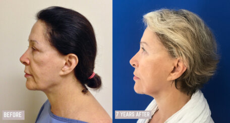 Minimally Invasive Midface Suspension (MIMS)-Ελάχιστα Επεμβατική Ανόρθωση Μέσης Επιφάνειας Προσώπου και Μεταφορά Λίπους στο Πρόσωπο