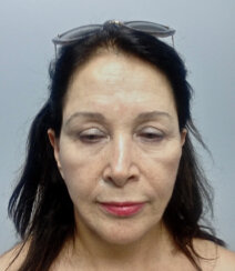 Minimally Invasive Midface Suspension (MIMS)-Ελάχιστα Επεμβατική Ανόρθωση Μέσης Επιφάνειας Προσώπου και Μεταφορά Λίπους στο Πρόσωπο