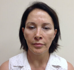 Minimally Invasive Midface Suspension (MIMS)-Ελάχιστα Επεμβατική Ανόρθωση Μέσης Επιφάνειας Προσώπου και Μεταφορά Λίπους στο Πρόσωπο