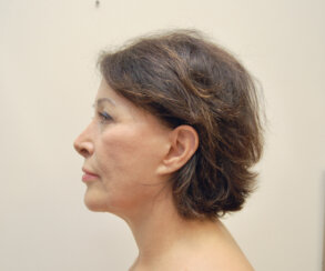 Minimally Invasive Midface Suspension (MIMS)-Ελάχιστα Επεμβατική Ανόρθωση Μέσης Επιφάνειας Προσώπου και Μεταφορά Λίπους στο Πρόσωπο