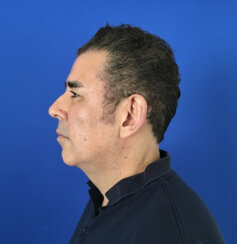 Ελάχιστα Eπεμβατικό Facelift