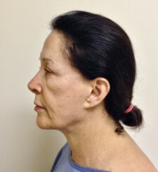 Minimally Invasive Midface Suspension (MIMS)-Ελάχιστα Επεμβατική Ανόρθωση Μέσης Επιφάνειας Προσώπου και Μεταφορά Λίπους στο Πρόσωπο
