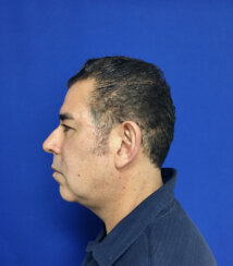 Ελάχιστα Eπεμβατικό Facelift