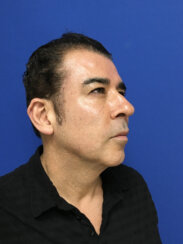 Ελάχιστα Eπεμβατικό Facelift
