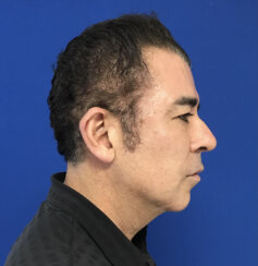 Ελάχιστα Eπεμβατικό Facelift