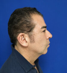 Ελάχιστα Eπεμβατικό Facelift