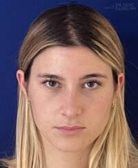 Μια γυναίκα με ίσια, ξανθά μαλλιά και καστανά μάτια κοιτάζει κατευθείαν την κάμερα μπροστά από ένα μπλε φόντο, αναδεικνύοντας διακριτικά τη φυσική ομορφιά που πέτυχε χάρη στη Ρινοπλαστική Αναμόρφωση Μύτης (rinoplastiki anamorfosi mytis).