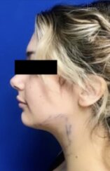 Γυναίκα σε προφίλ με φόντο μπλε, με μαύρες ρίγες στα μάτια και χειρουργικά σημάδια στο κάτω μέρος του μάγουλου και του λαιμού, που απεικονίζει τη διαδικασία της Διόρθωσης Λαιμού και της Λιποαναρρόφησης Διπλού Πηγουνιού (λιποαναρρόφηση διπλού πηγουνιού), όπως φαίνεται στις φωτογραφίες πριν από την επέμβαση.